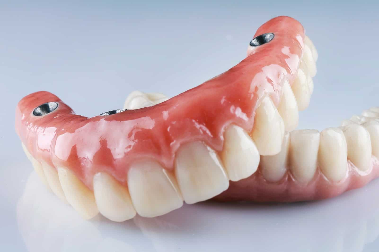 Overdentures at Renovo Prosthodontics in Salt Lake City Utah